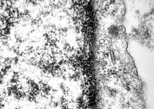 M,15y. | eosinophilic granuloma Birbeck granule [body]